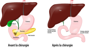peut-on vivre sans le pancréas