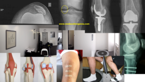 peut-on marcher avec une rupture des ligaments croisés